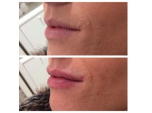 Lip Fillers In Berea