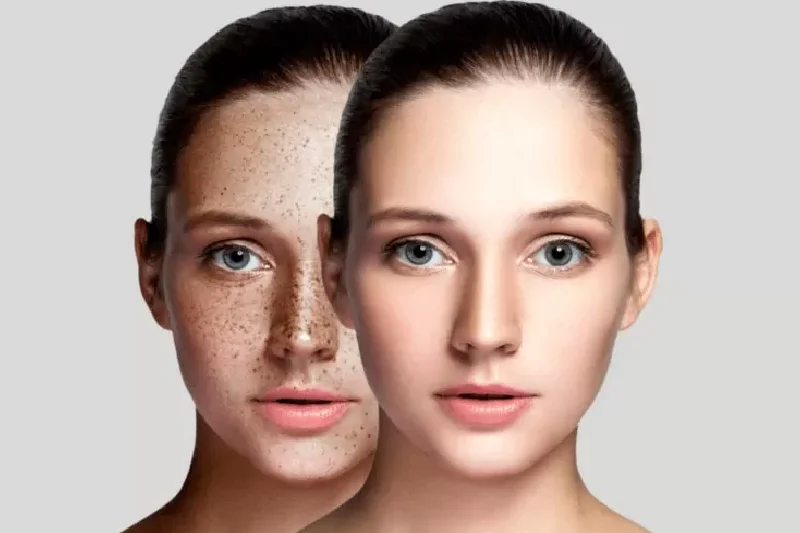 Hyperpigmentation Issues