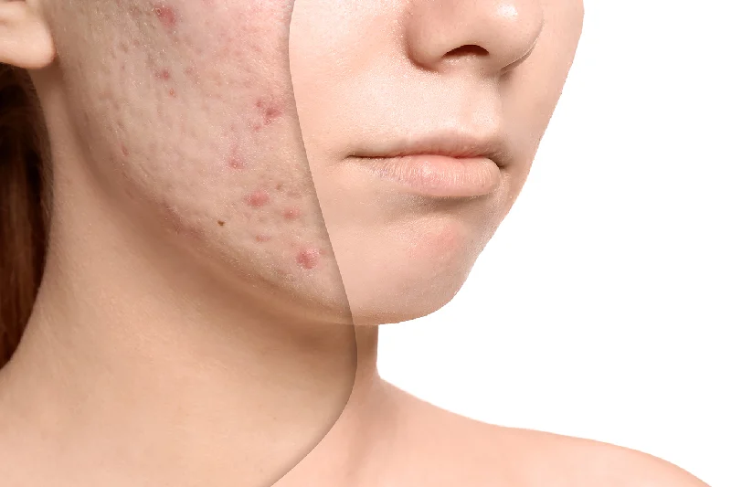 Skin Pores & Blackheads