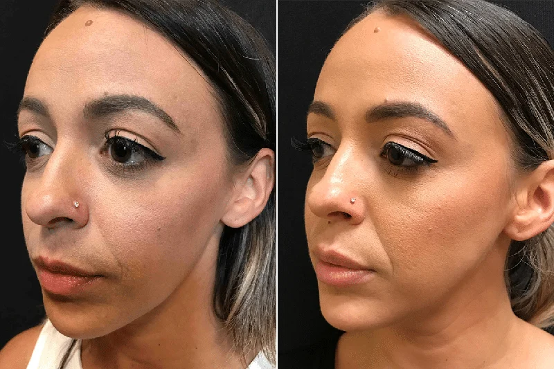 Juvederm Ultra