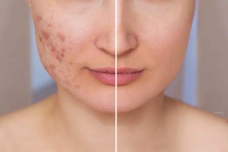 Acne Scars