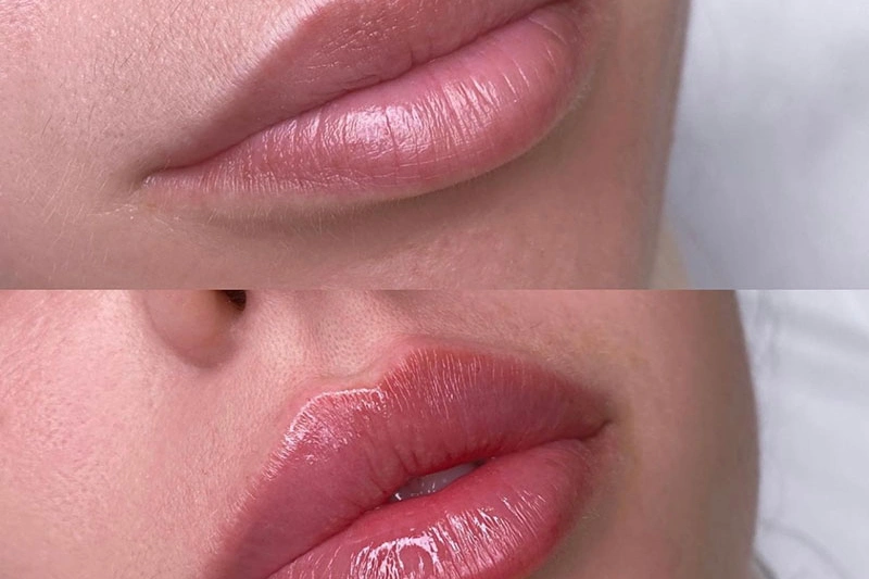 Juvederm Ultra