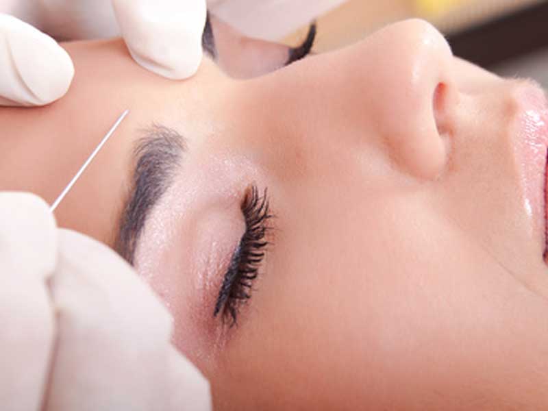 Microneedling
