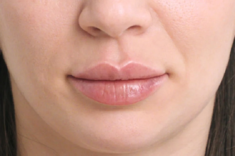 Restylane Kysse