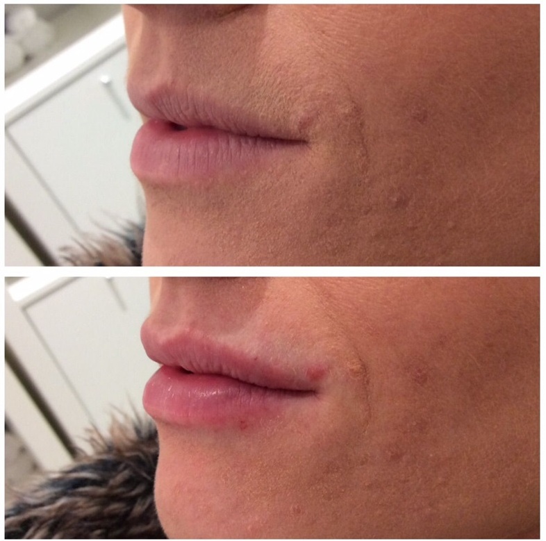 
Juvederm Ultra Smile